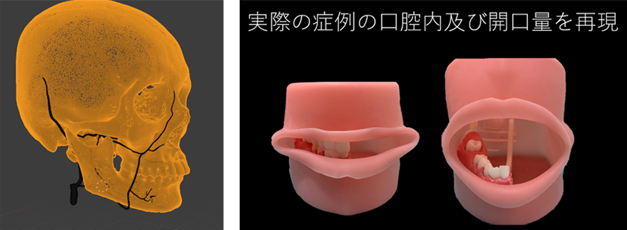 5GとVR・AR技術、3Dプリンティング技術を活用し東京の指導医が大阪の若手歯科医による歯科手術を遠隔支援